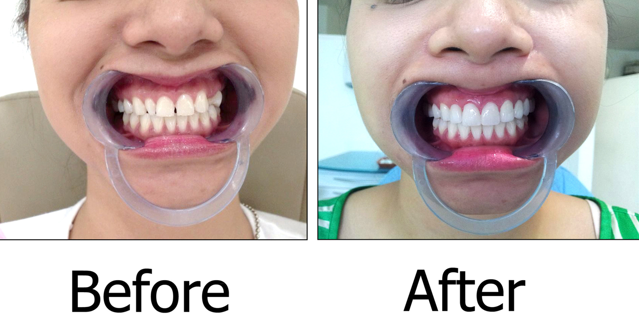 teeth whitening in joburg