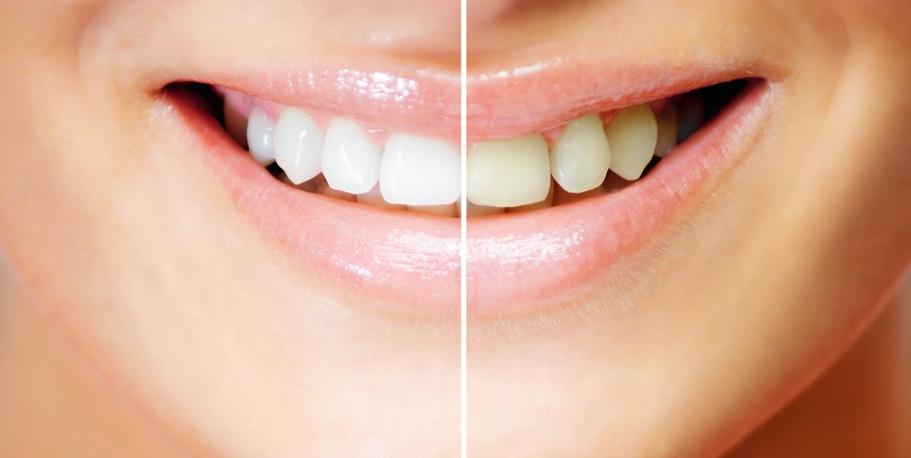 laser teeth whitening gauteng